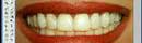 photoshop-blanquear-dientes